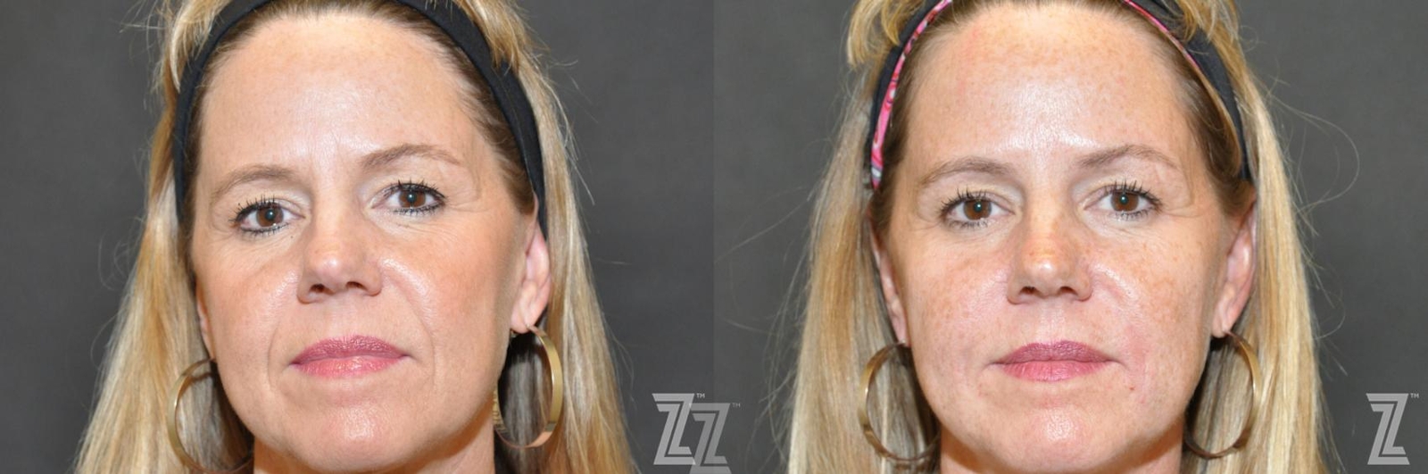 Austin Facial Rejuvenation Before & After Gallery - Patient 186050 - Image 1 - The Piazza Center