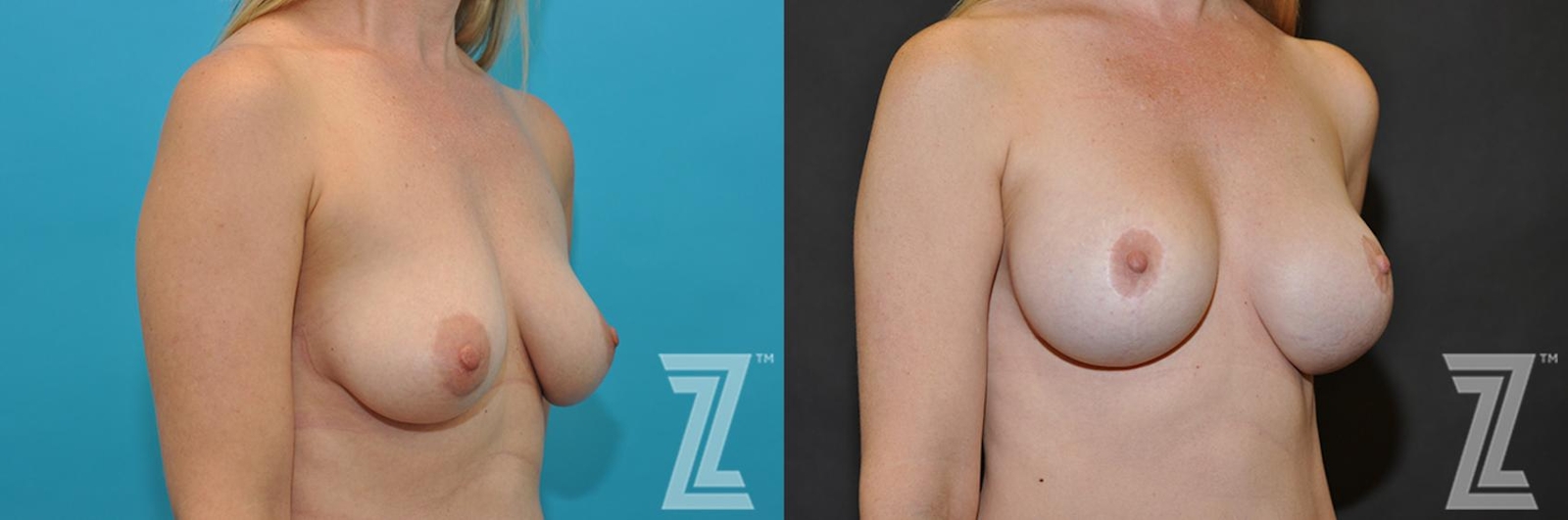 Austin Breast Augmentation With a Breast Lift Before & After Gallery - Patient 132791112 - Image 5 - The Piazza Center