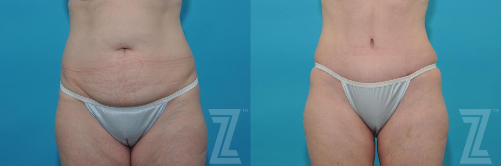 Austin Tummy Tuck Before & After Gallery - Patient 132886814 - Image 1 - The Piazza Center