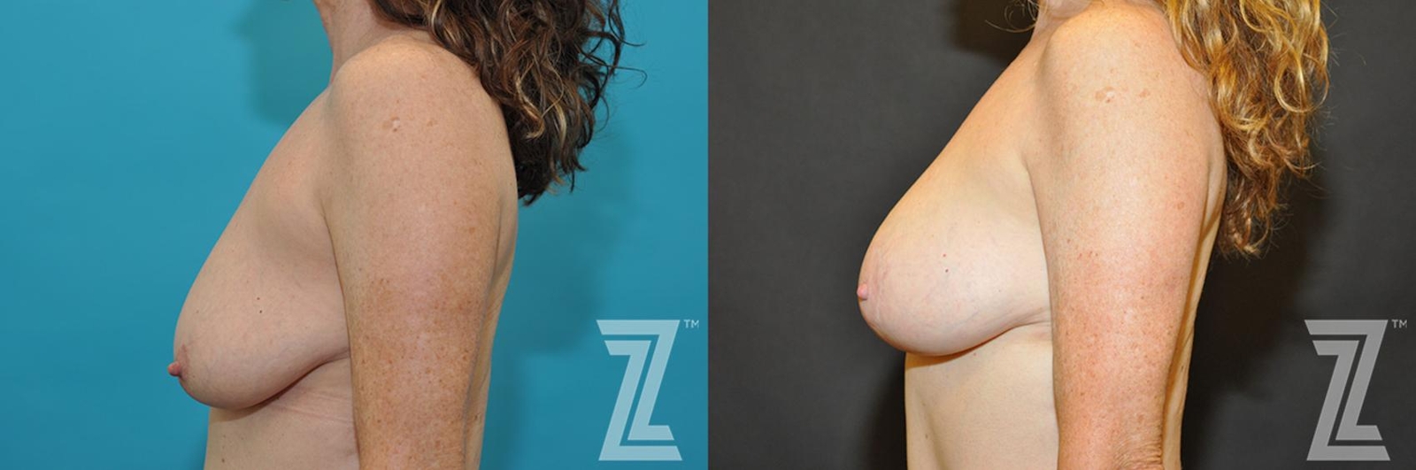 Austin Breast Augmentation With a Breast Lift Before & After Gallery - Patient 132791131 - Image 3 - The Piazza Center