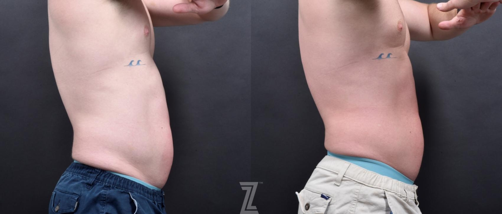 Austin Emsulpt Neo® Before & After Gallery - Patient 132905398 - Image 1 - The Piazza Center