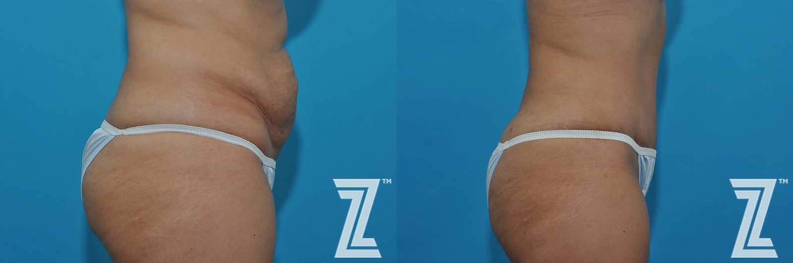 Austin Tummy Tuck Before & After Gallery - Patient 132886863 - Image 5 - The Piazza Center