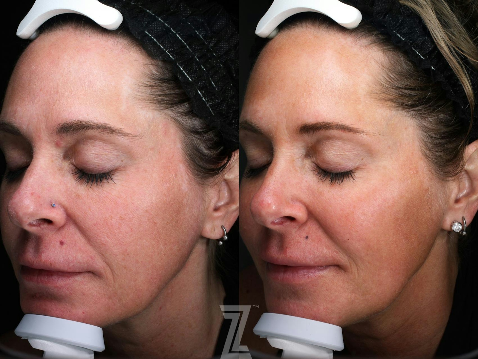 Austin Visia Skincare Analysis Before & After Gallery - Patient 132963268 - Image 2 - The Piazza Center