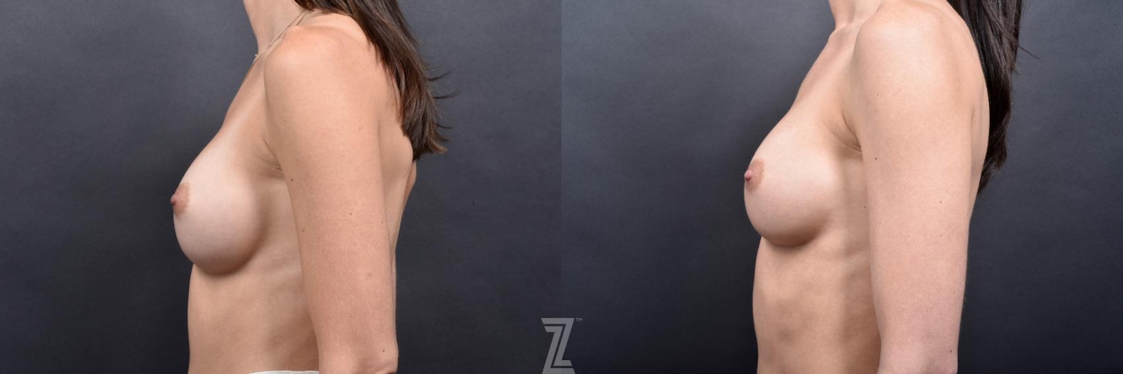 Austin Breast Augmentation Revision Before & After Gallery - Patient 132886545 - Image 3 - The Piazza Center
