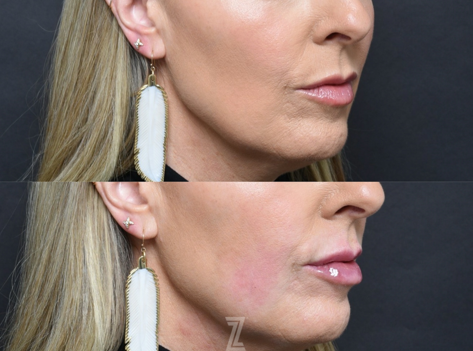 Austin Injectable Lip Fillers - The Piazza Center