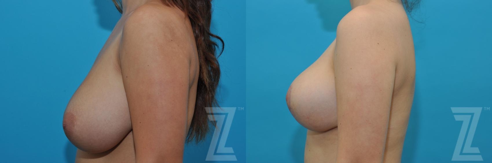 Austin Breast Reduction Before & After Gallery - Patient 132886608 - Image 3 - The Piazza Center