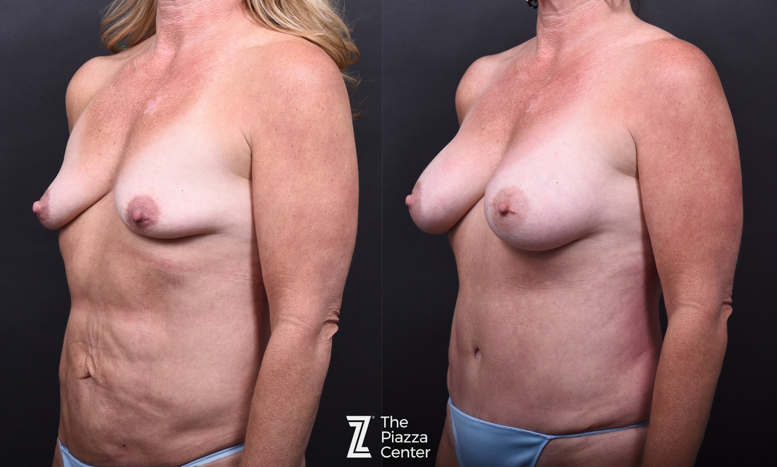 Austin Breast Augmentation Before & After Gallery - Patient 158035 - Image 4 - The Piazza Center