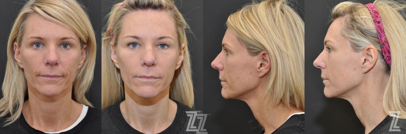 Austin Chemical Peel Before & After Gallery - Patient 132963245 - Image 1 - The Piazza Center