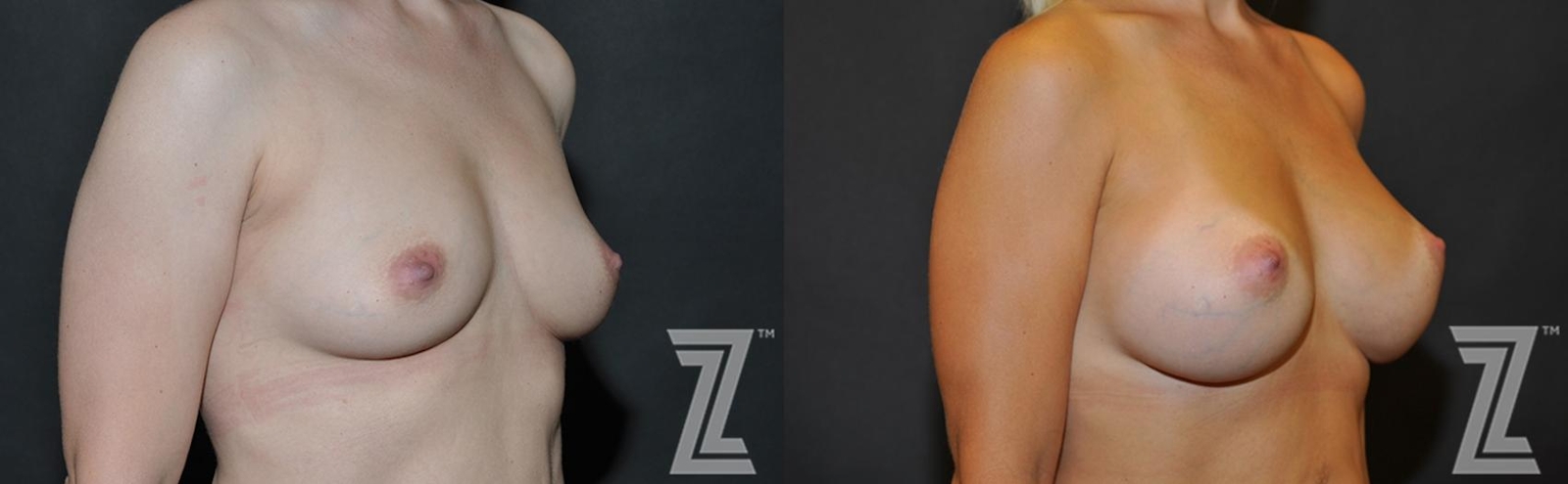Austin 6 Months After Breast Augmentation in Austin, TX Before & After by Dr. Rocco Piazza - Oblique View - The Piazza Center