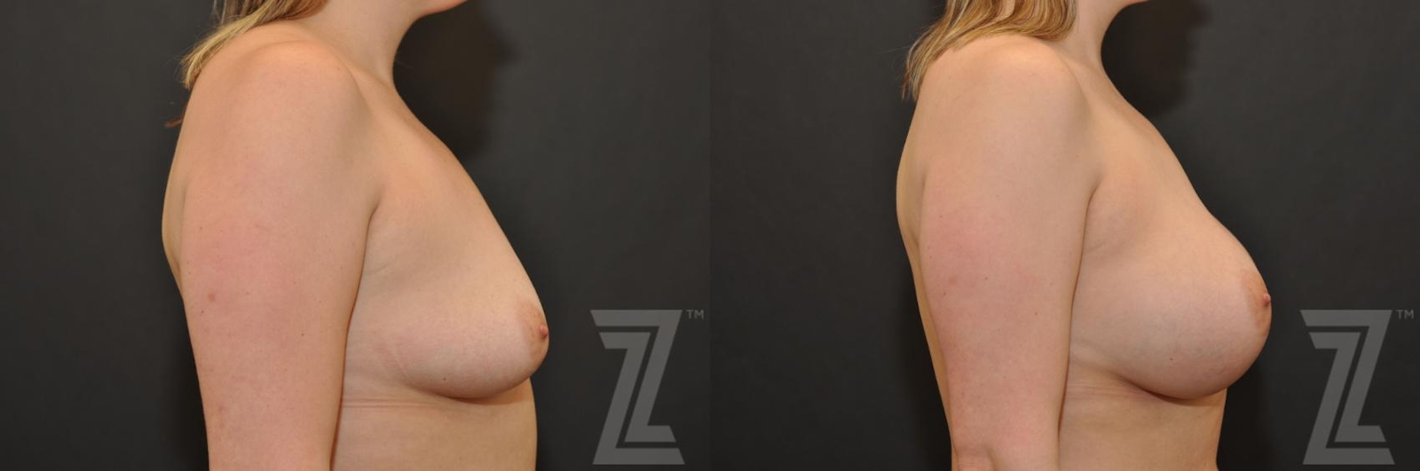 Austin Side view before and after images of 32 year old woman with Silicone Implants with Cohesive Silicone Gel - The Piazza Center