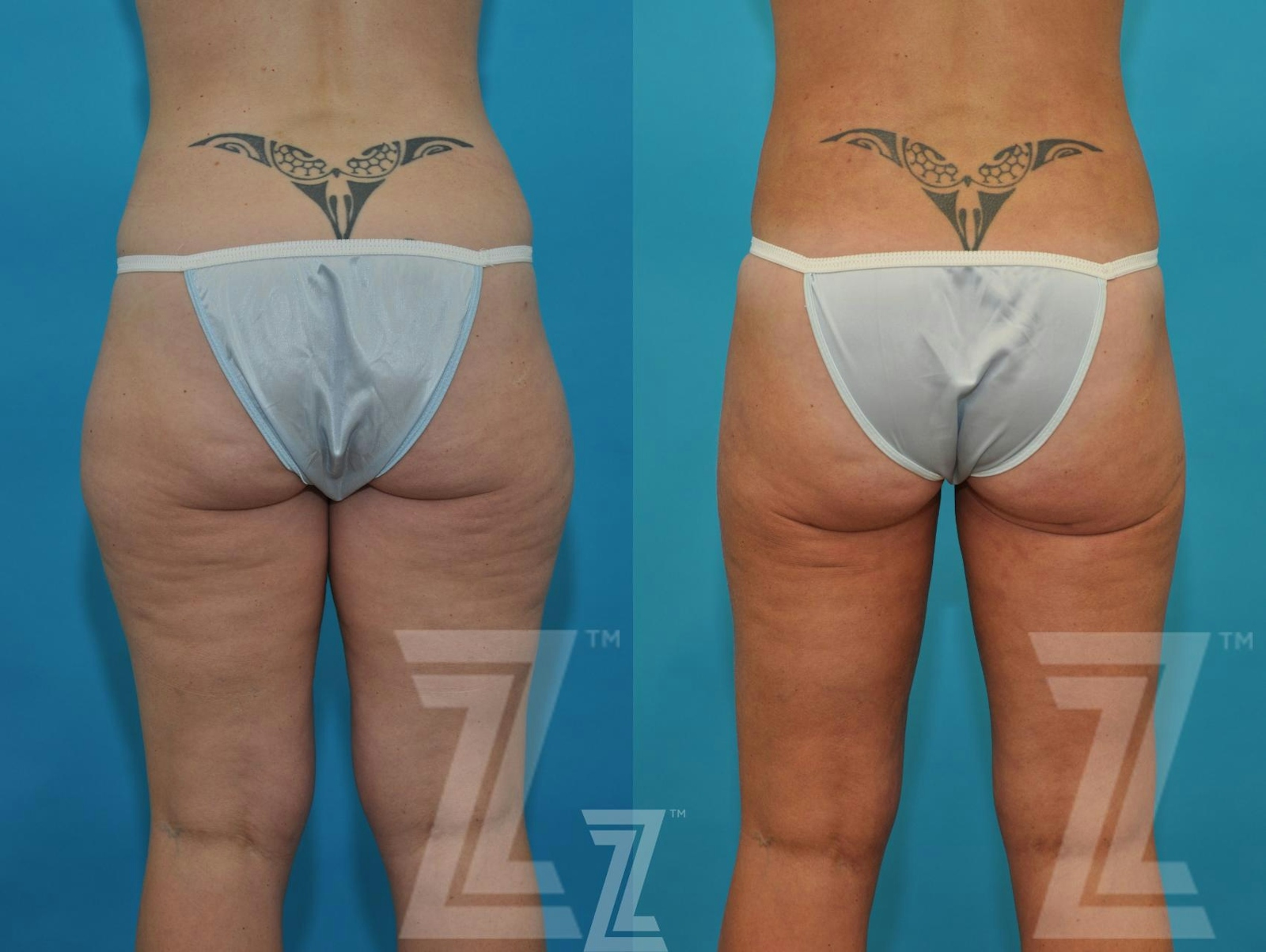 Austin Liposuction Before & After Gallery - Patient 132895980 - Image 2 - The Piazza Center
