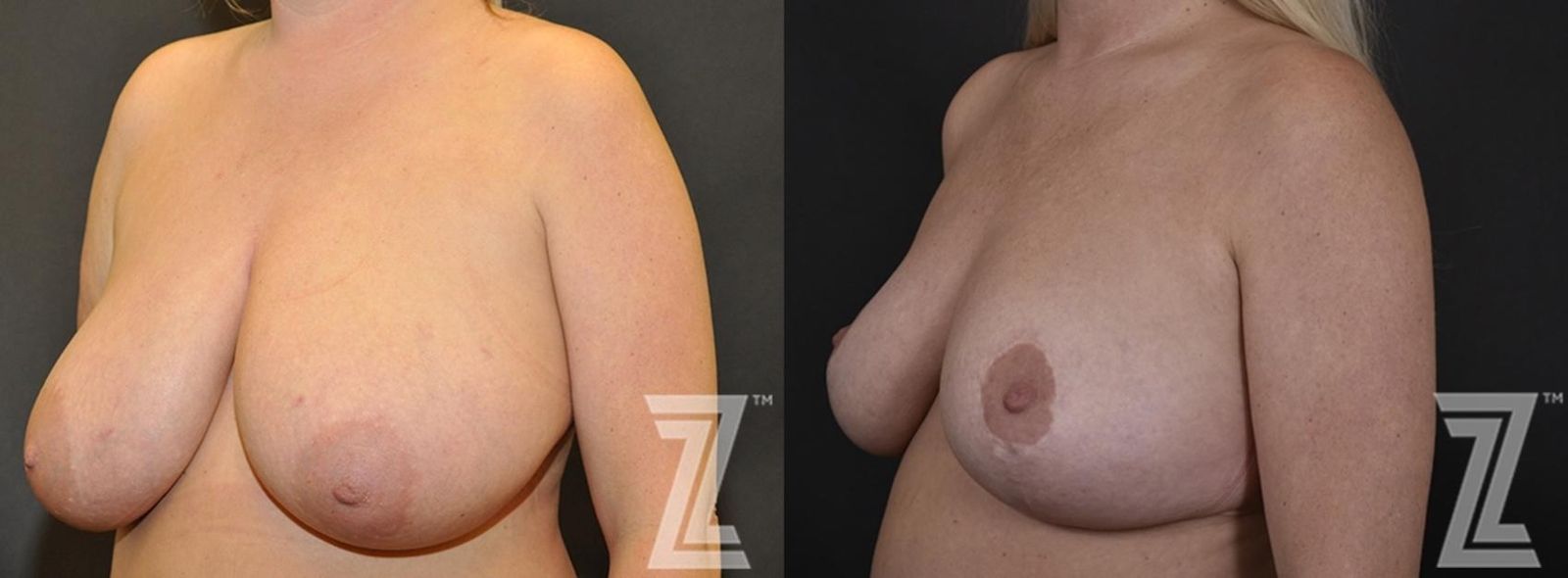 Austin Breast Reduction Before & After Gallery - Patient 132886746 - Image 2 - The Piazza Center