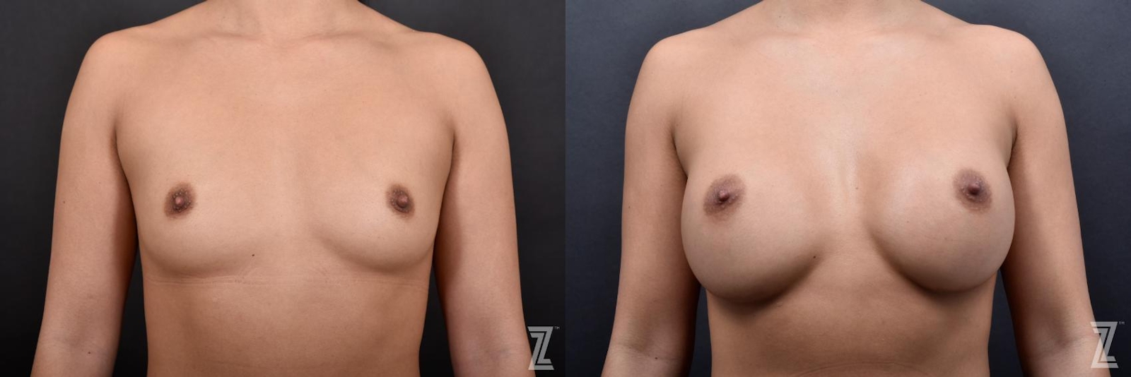 Austin Before & After Breast Augmentation of 25-Year-Old Female Patient at The Piazza Center in Austin - Dr. Piazza - The Piazza Center