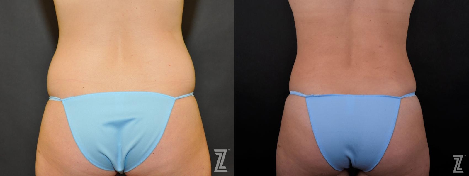 Austin Tummy Tuck Before & After Gallery - Patient 132886895 - Image 6 - The Piazza Center