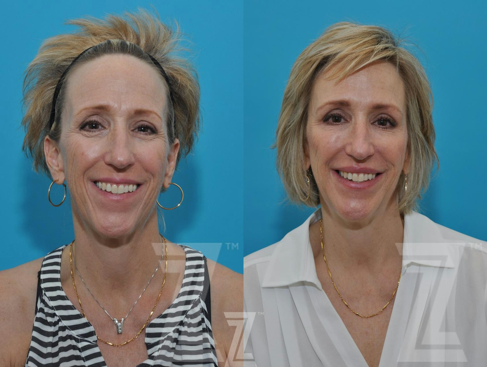 Austin Injectable Fillers Before & After Gallery - Patient 132963096 - Image 2 - The Piazza Center