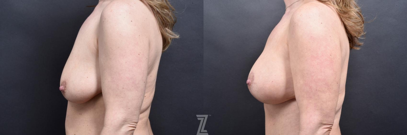 Austin Lateral View of Breast of 41-Year-Old 7 month post op Mommy Makeover Before & After by Dr. Rocco Piazza in Austin, Texas - The Piazza Center