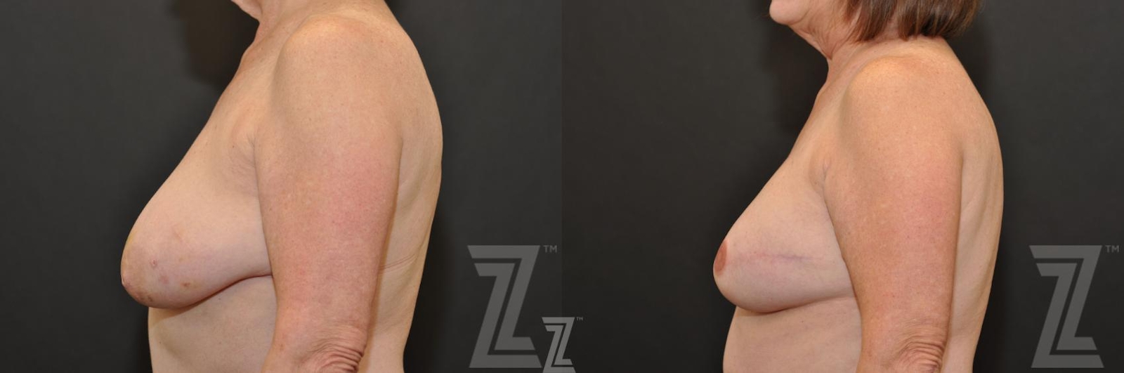 Austin Breast Reconstruction Before & After Gallery - Patient 132886766 - Image 3 - The Piazza Center