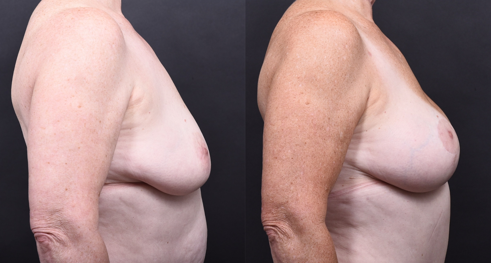 Austin Breast Augmentation With a Breast Lift Before & After Gallery - Patient 438571 - Image 3 - The Piazza Center