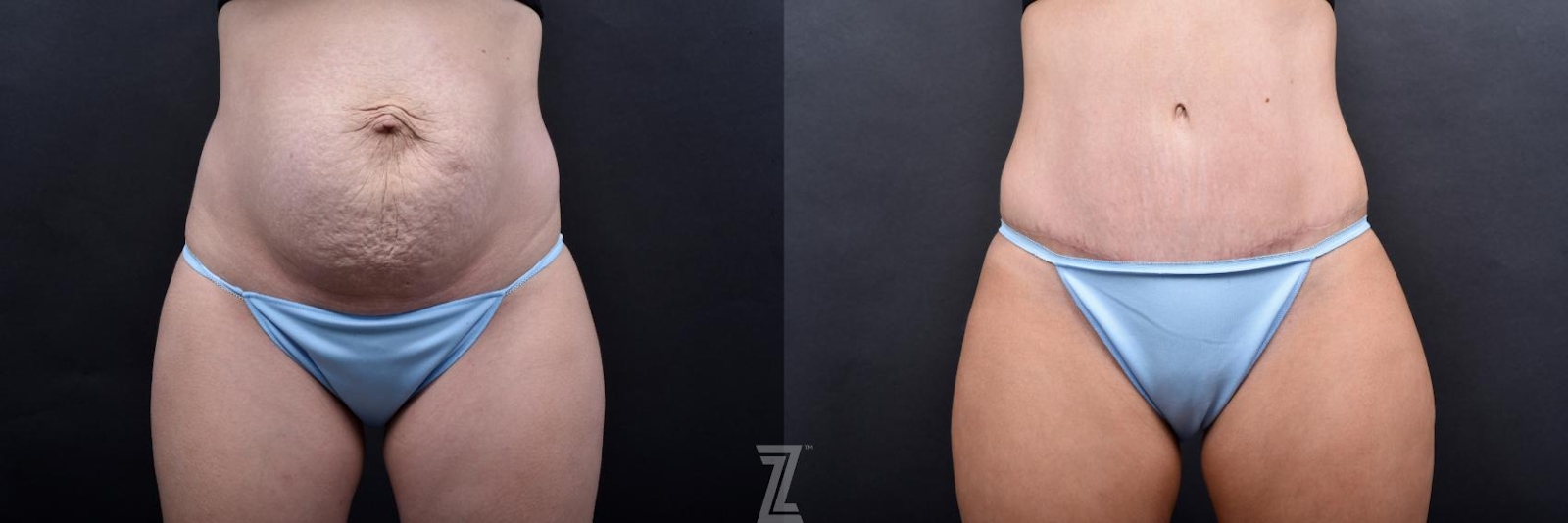 Austin Tummy Tuck Before & After Gallery - Patient 132886800 - Image 1 - The Piazza Center