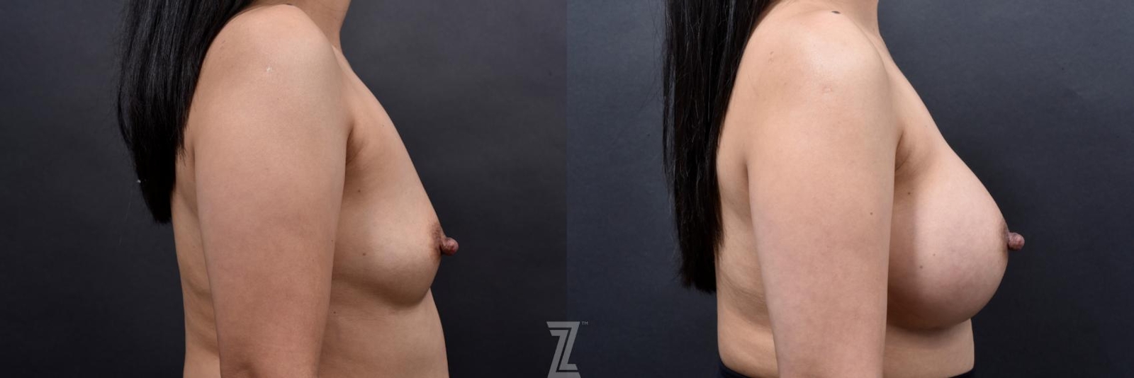 Austin before & after lateral view of 41 year old woman with Silicone Implants with Cohesive Silicone Gel - The Piazza Center - The Piazza Center