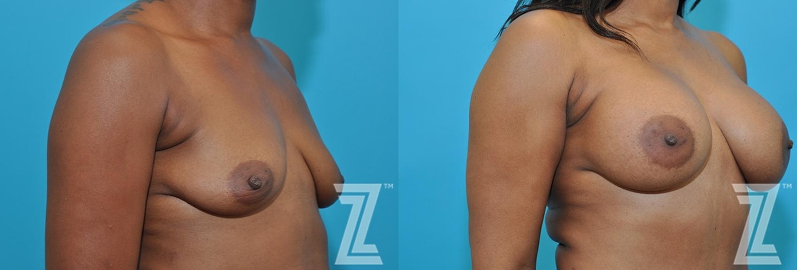 Austin 2 year post op oblique view breast view of 43-year-old mother of two mommy maker over - Dr. Rocco Piazza - The Piazza Center