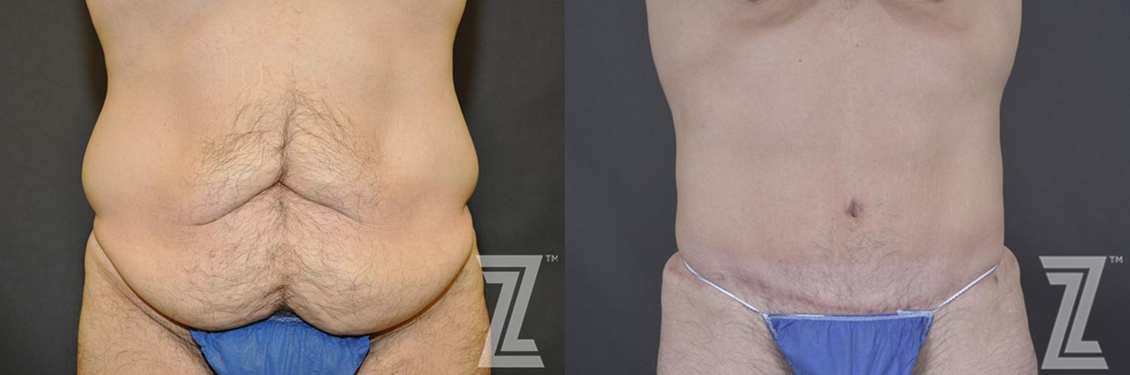 Austin Male Body Contouring Before & After Gallery - Patient 183281 - Image 1 - The Piazza Center
