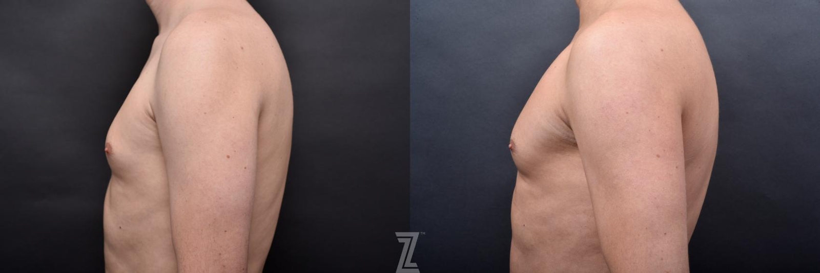 Austin Male Body Contouring Before & After Gallery - Patient 273342 - Image 6 - The Piazza Center