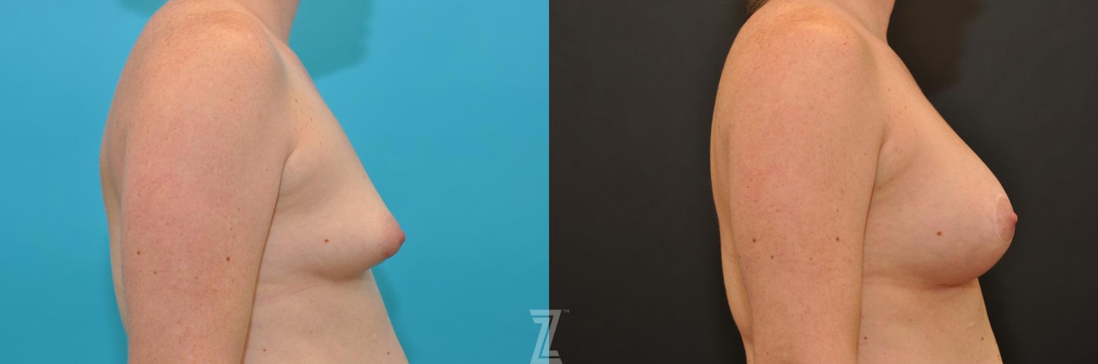 Austin Breast Augmentation With a Breast Lift Before & After Gallery - Patient 132791097 - Image 5 - The Piazza Center