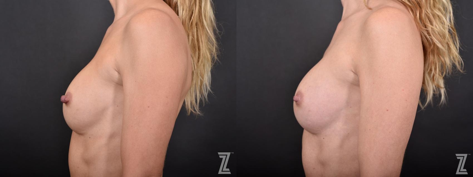 Austin Nipple Reduction Before & After Gallery - Patient 132886788 - Image 3 - The Piazza Center