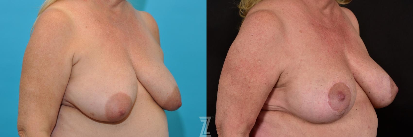 Austin Breast Lift Before & After Gallery - Patient 132791071 - Image 4 - The Piazza Center