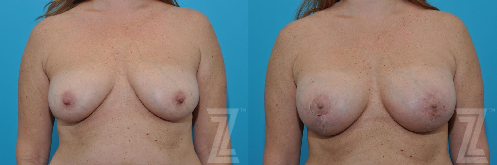 Austin Breast Augmentation With a Breast Lift Before & After Gallery - Patient 132791088 - Image 1 - The Piazza Center