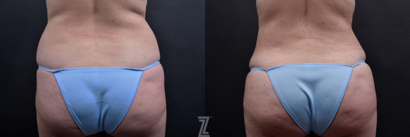 Austin Tummy Tuck Before & After Gallery - Patient 132886885 - Image 4 - The Piazza Center