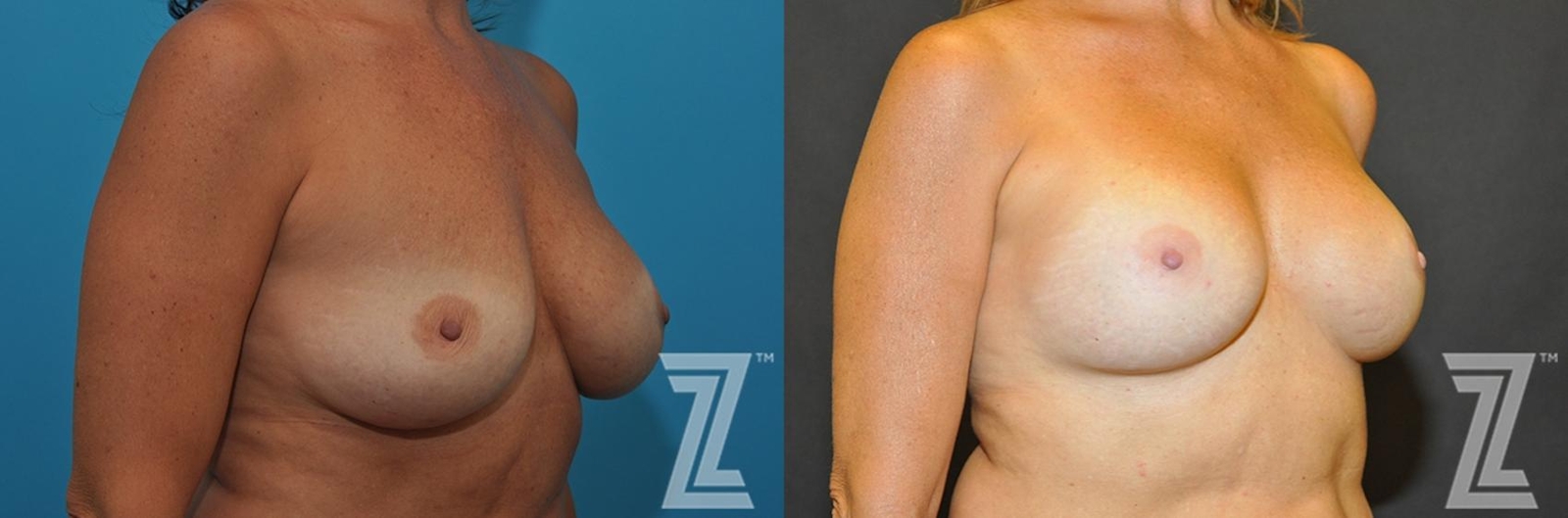 Austin Breast Augmentation Revision Before & After Gallery - Patient 132886563 - Image 4 - The Piazza Center