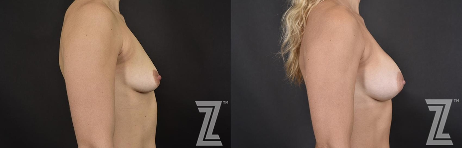 Austin Side view before & after images of 32 year old woman with breat augmentation at the Piazza Center - The Piazza Center