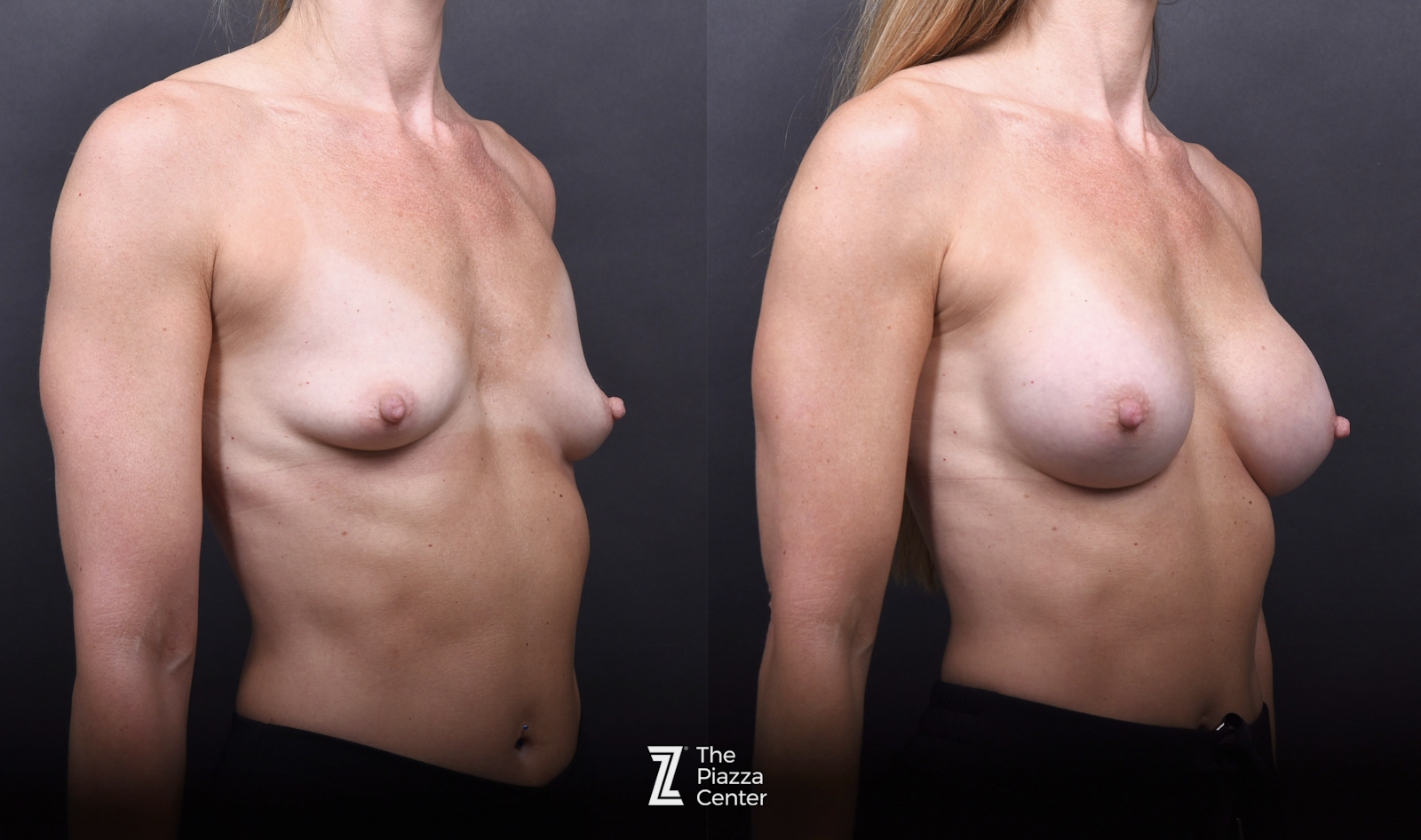 Austin Breast Augmentation Before & After Gallery - Patient 428919 - Image 2 - The Piazza Center