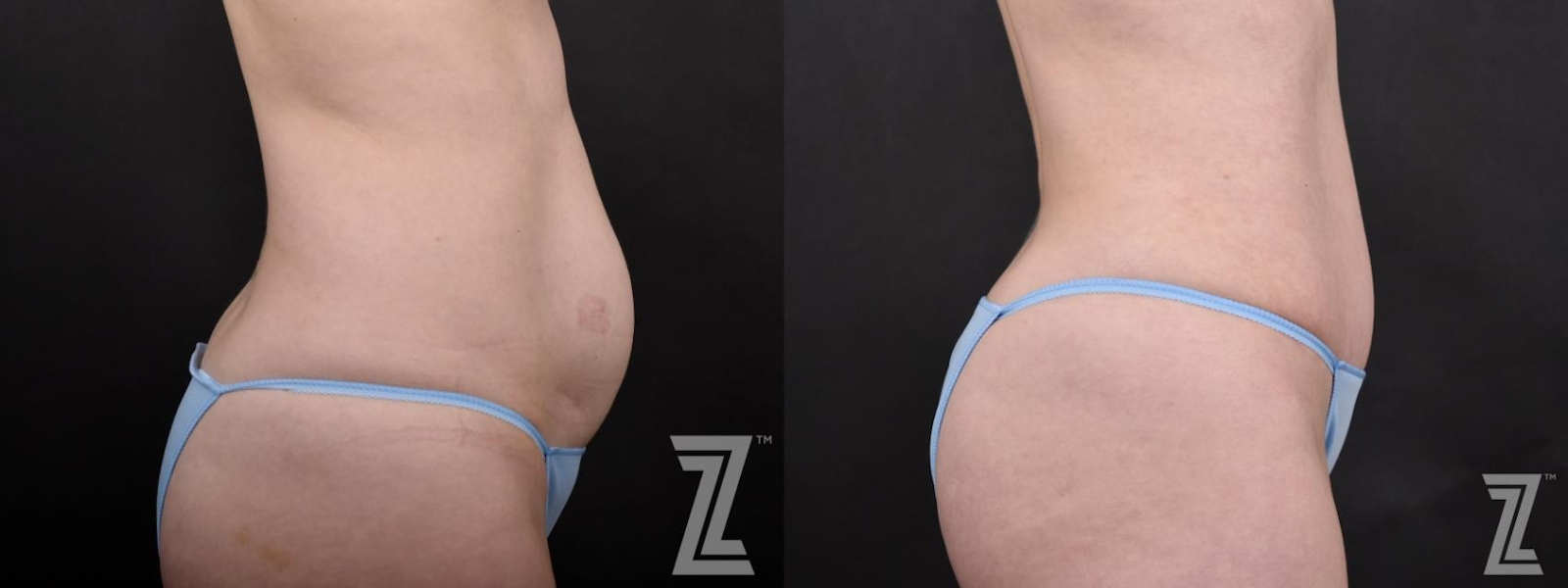 Austin Lateral View of Tummy from Mommy Makeover with Surgical Plan for a Breast Augmentation and a Contoured Waistline With an Abdominoplasty in Austin, TX by Dr. Rocco Piazza - Before & After Image - The Piazza Center