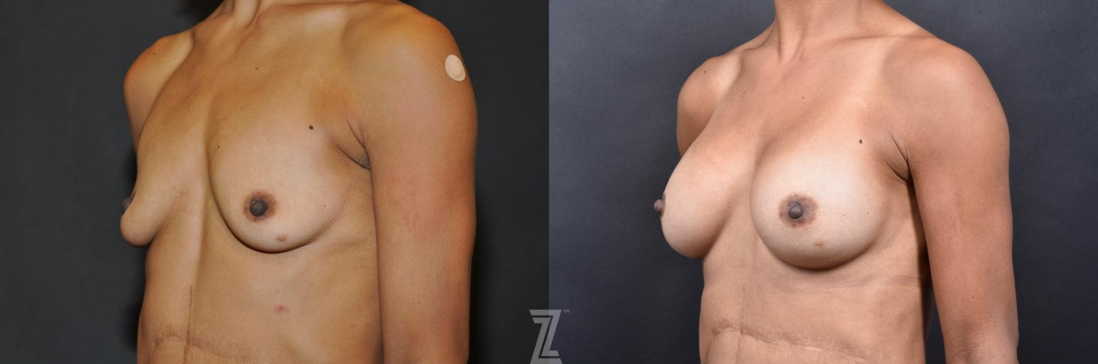 Austin Oblique view before & after images of 35-year-old mother with breat augmentation - Dr. Rocco Piazza - The Piazza Center