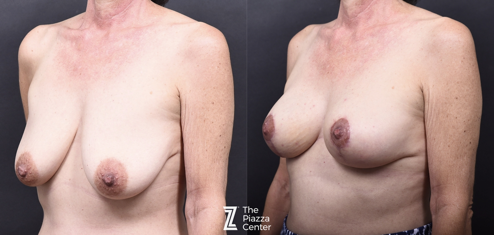 Austin Breast Augmentation With a Breast Lift - The Piazza Center