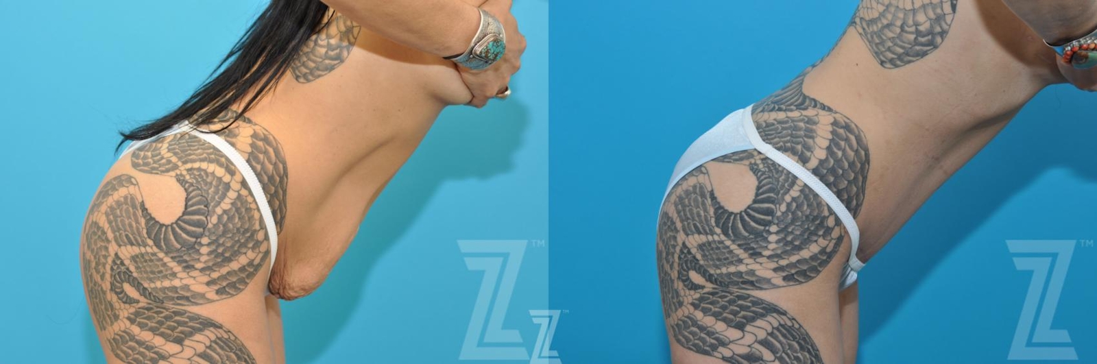 Austin Tummy Tuck Before & After Gallery - Patient 377913 - Image 4 - The Piazza Center
