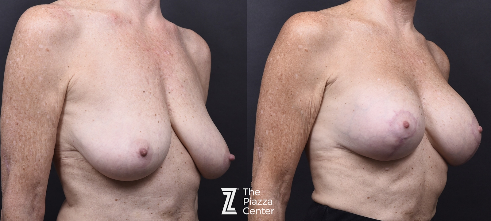 Austin Breast Augmentation With a Breast Lift Before & After Gallery - Patient 296286 - Image 2 - The Piazza Center