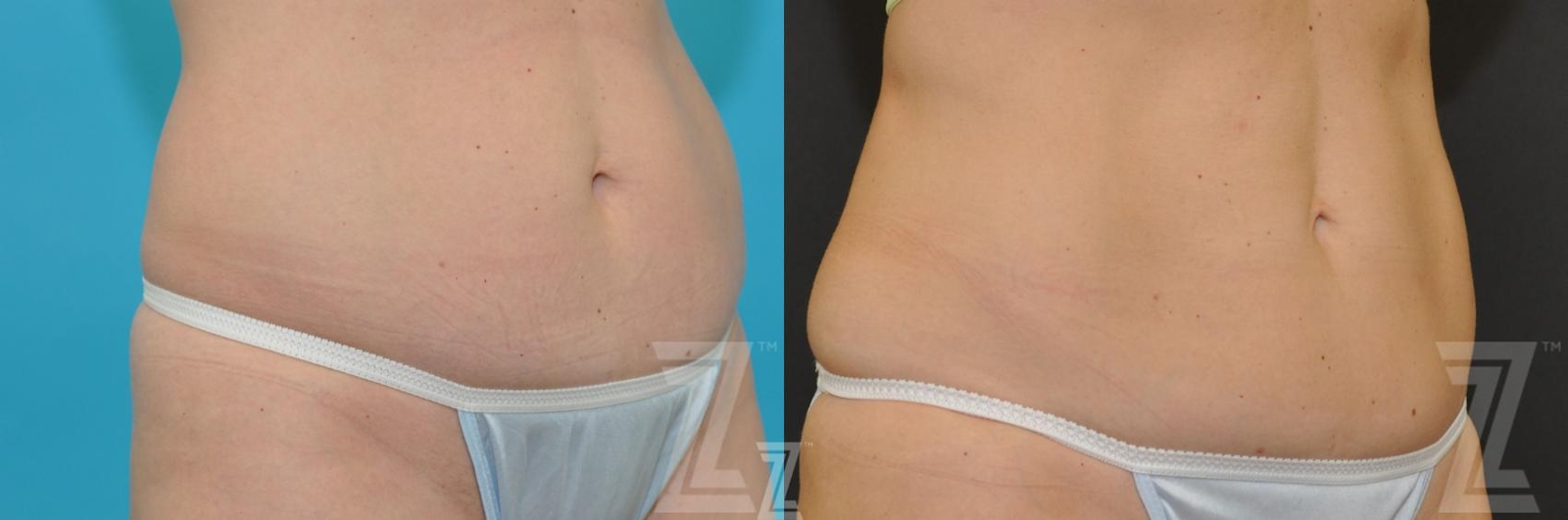 Austin CoolSculpting® Before & After Gallery - Patient 132905390 - Image 1 - The Piazza Center