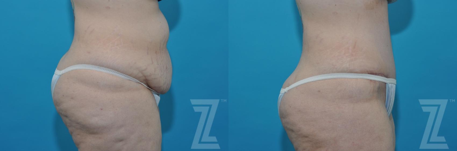 Austin Tummy Tuck Before & After Gallery - Patient 132886824 - Image 5 - The Piazza Center