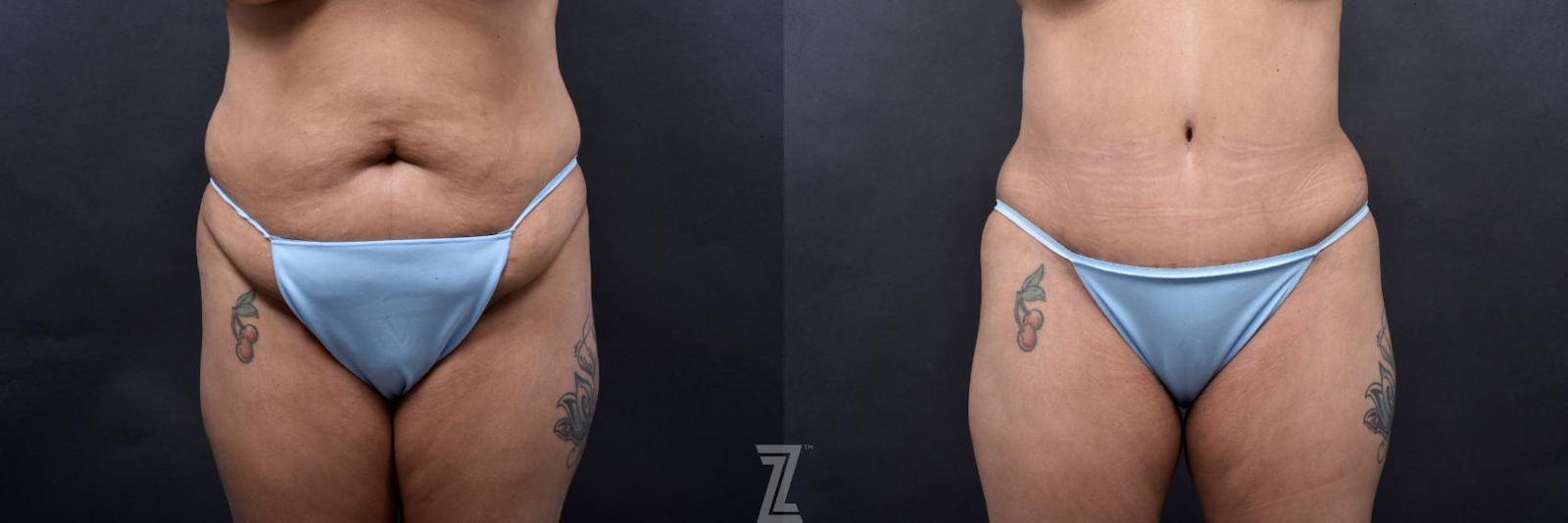 Austin Front Abdomen View 6 Month Post-OP Mommy Makeover in Austin, TX by Dr. Rocco Piazza - The Piazza Center