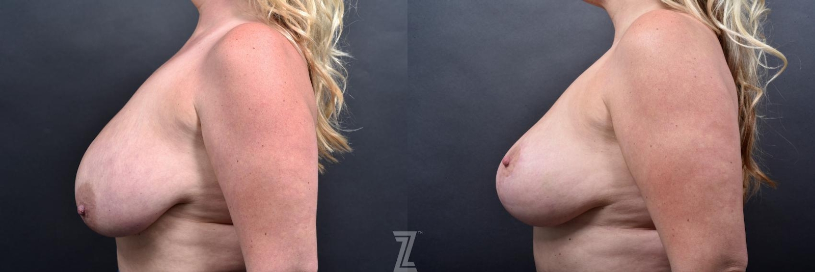 Austin Breast Reduction Before & After Gallery - Patient 132886609 - Image 3 - The Piazza Center