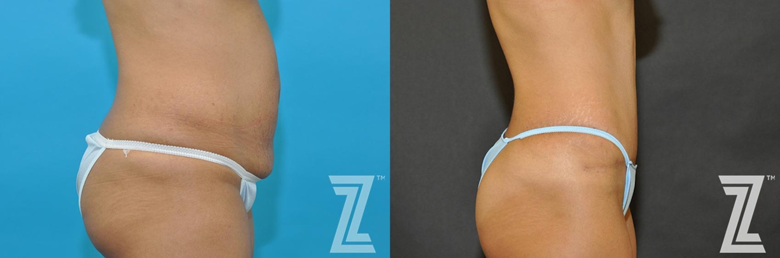 Austin Tummy Tuck Before & After Gallery - Patient 132886888 - Image 4 - The Piazza Center