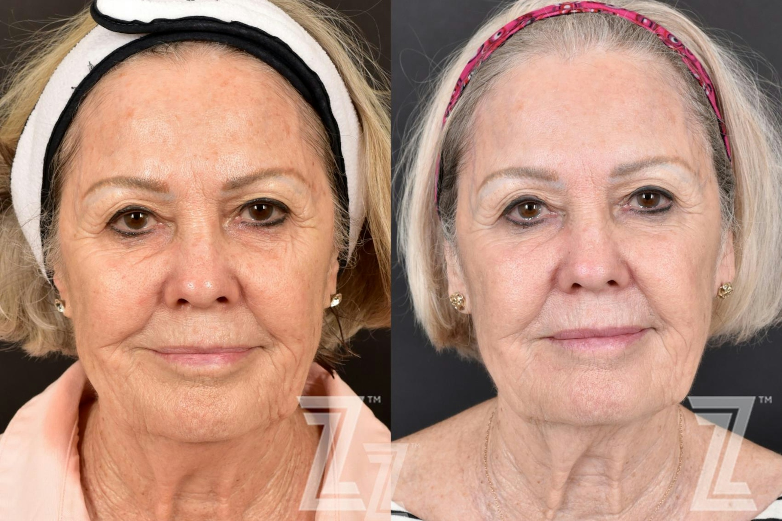 Austin HALO Before & After Gallery - Patient 132963261 - Image 1 - The Piazza Center