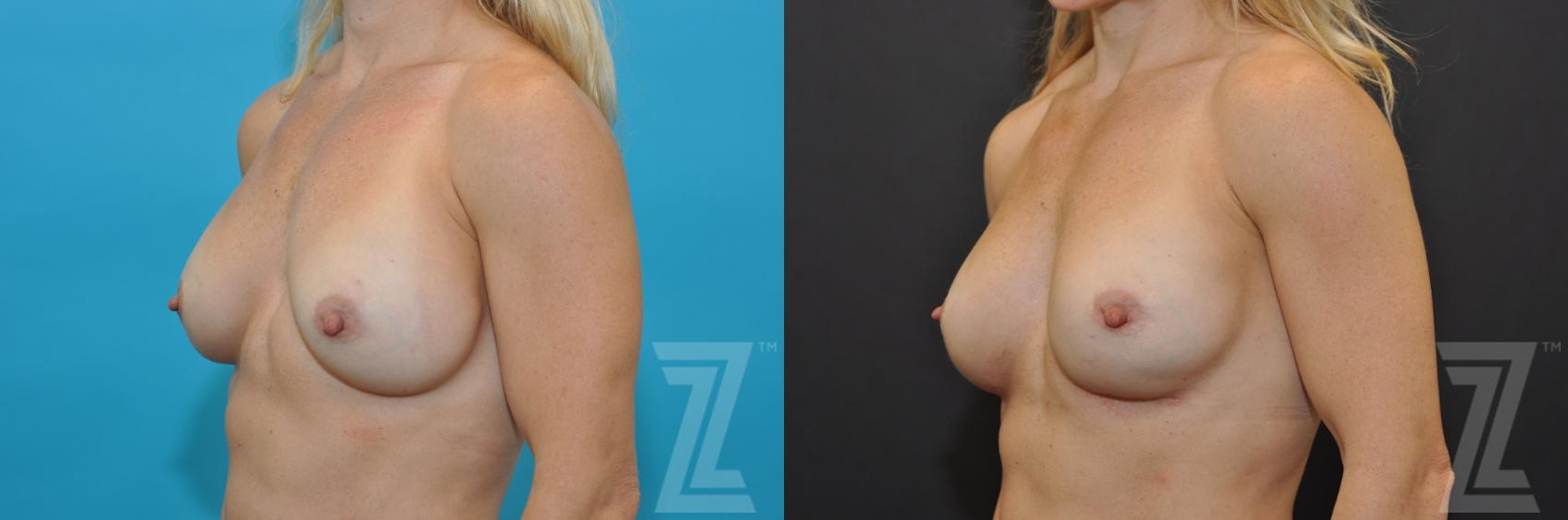 Austin Breast Augmentation Revision Before & After Gallery - Patient 132886580 - Image 2 - The Piazza Center