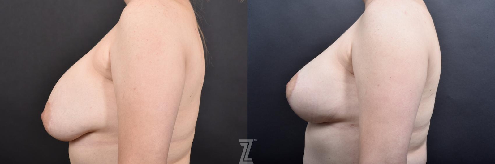 Austin Breast Augmentation Revision Before & After Gallery - Patient 132886548 - Image 3 - The Piazza Center