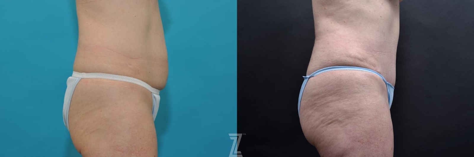 Austin Side abdominal view 7 year post op mommy makeover - The Piazza Center, Austin Tx - The Piazza Center