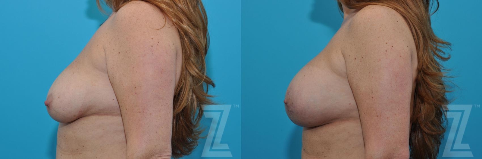 Austin Breast Augmentation With a Breast Lift Before & After Gallery - Patient 132791088 - Image 3 - The Piazza Center